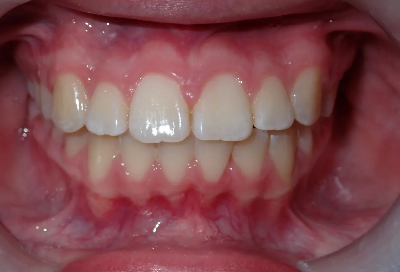 After orthodontic treatment showing Isabella's straight, aligned teeth