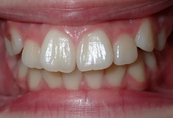 Before orthodontic treatment showing Isabella's misaligned teeth with spacing