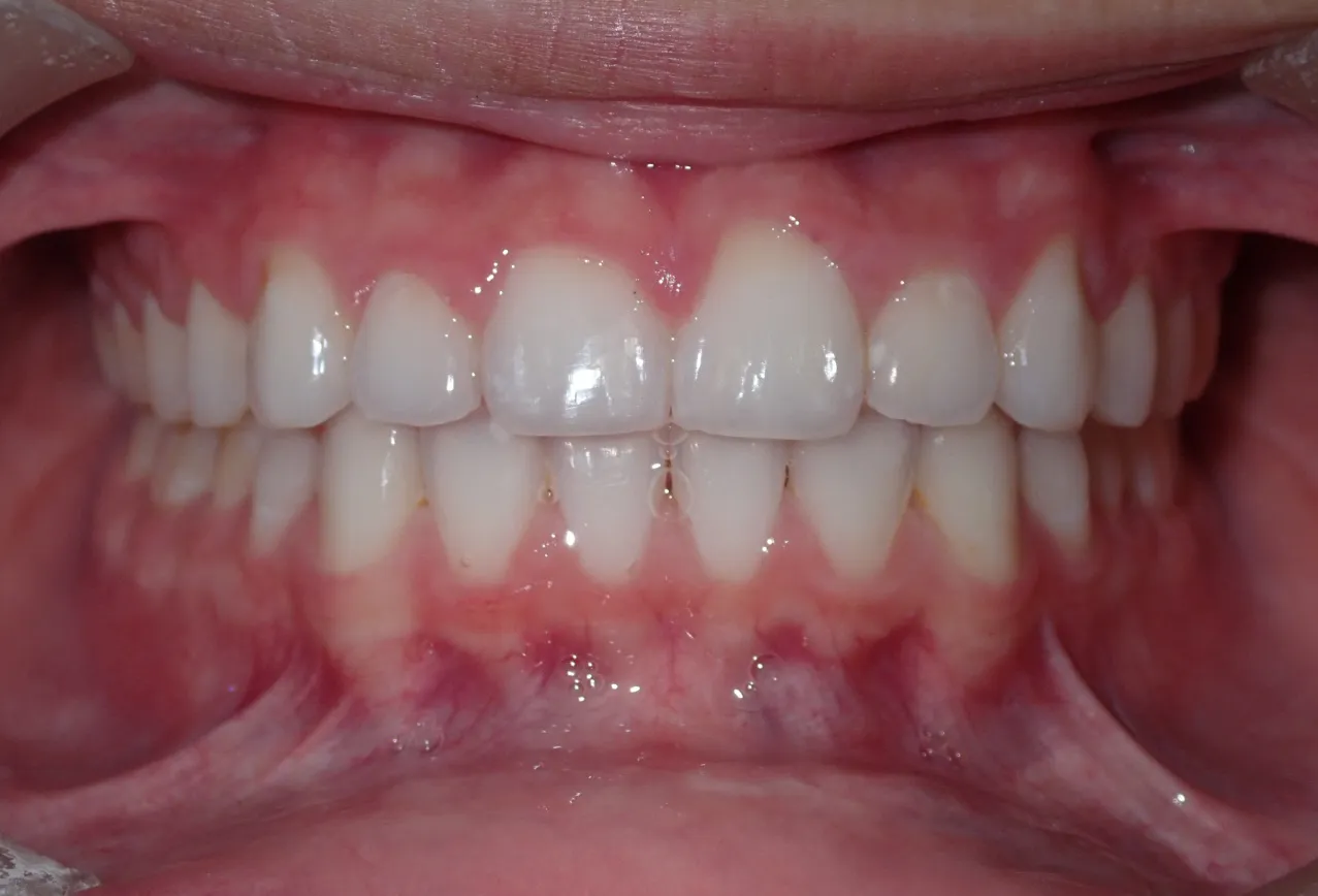 After treatment photo of Johrden's straightened teeth with improved bite