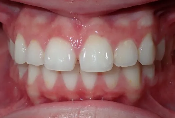Before treatment photo of Johrden's crowded teeth with gaps