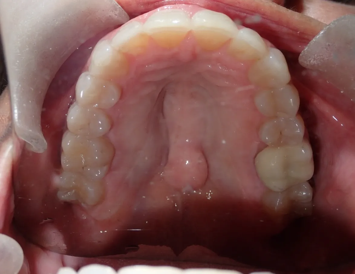 After orthodontic treatment showing Reeves’ improved tooth alignment and healthy gums