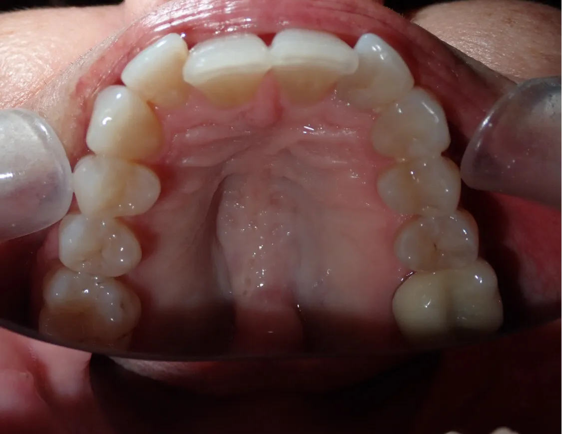 Close-up before treatment of Reeves’ misaligned teeth and bite issues