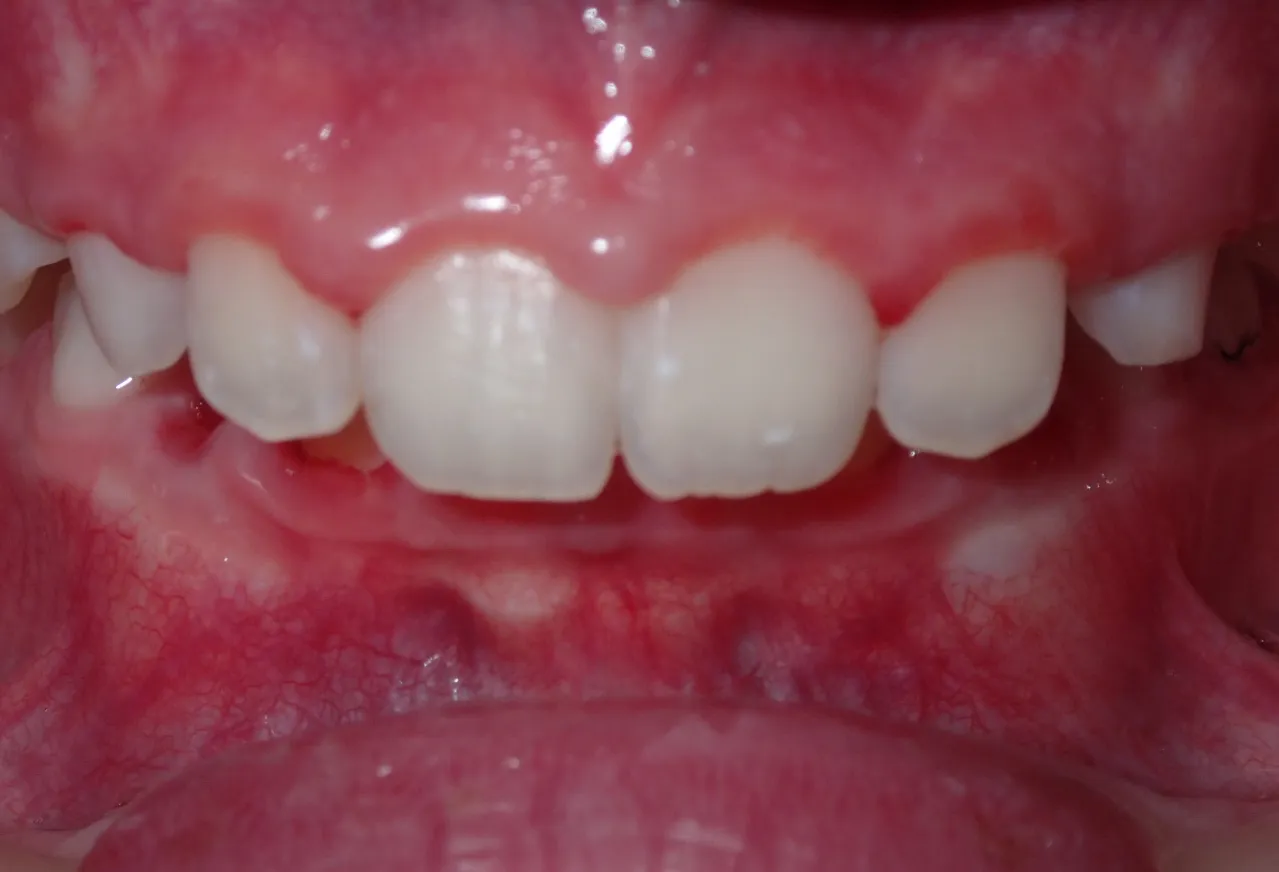 After orthodontic treatment showing Steel’s straight, even smile