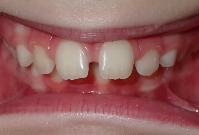 Before orthodontic treatment showing Steel’s crowded and uneven teeth